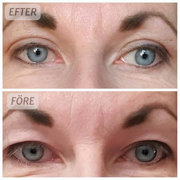 BrighSkin™ Osynligt Ögonlockslyft